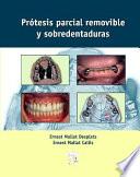 Libro Prótesis parcial removible y sobredentaduras
